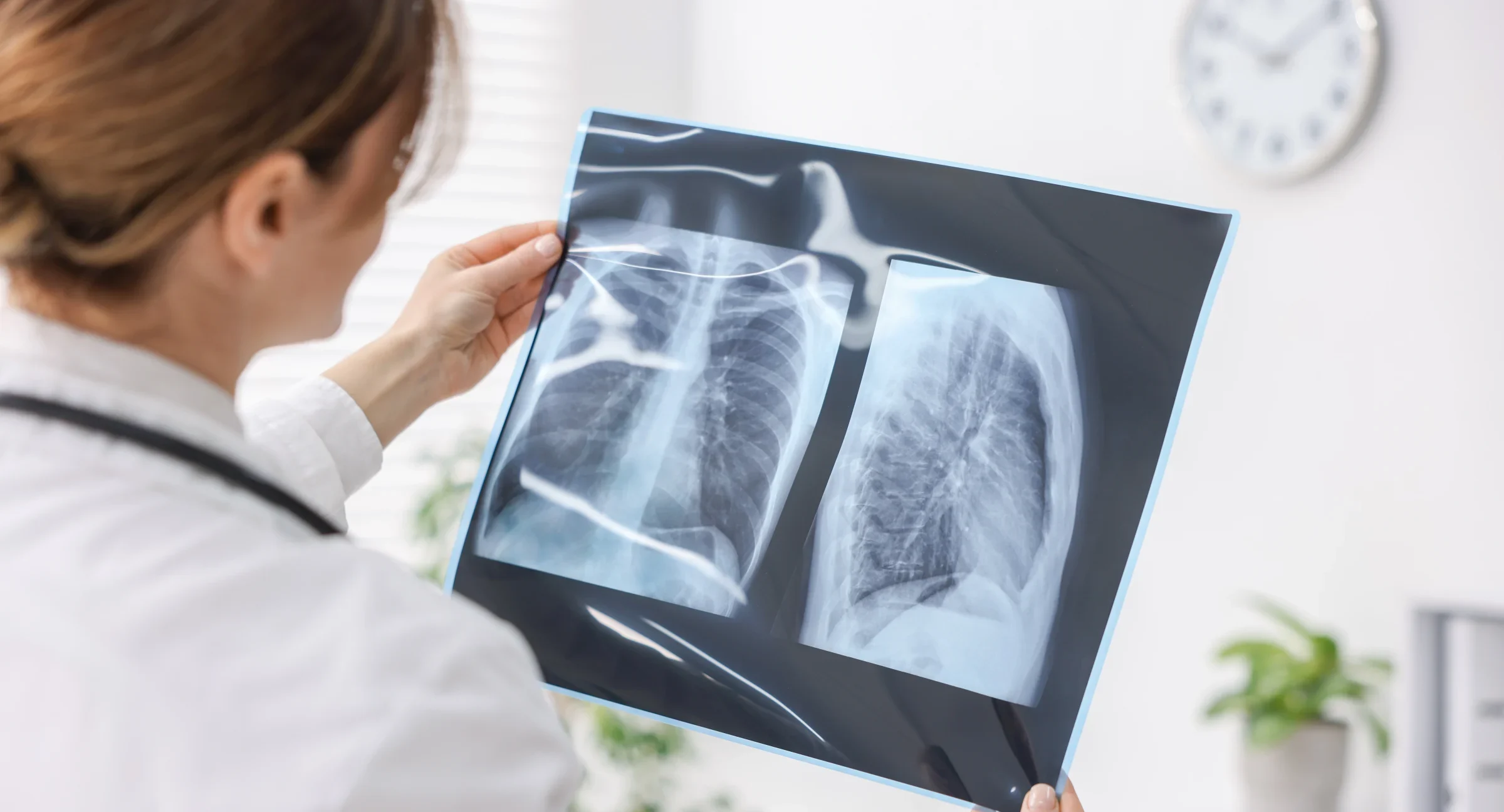 When Vaping Turns Dangerous: Recognizing Lung Injuries Caused by Vaping