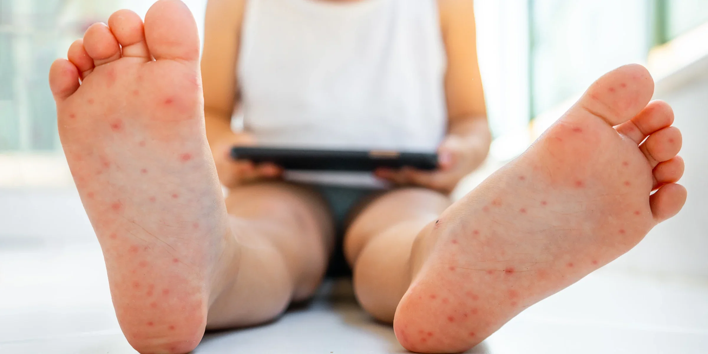 Measles Outbreak in Texas: Essential Guide for Parents